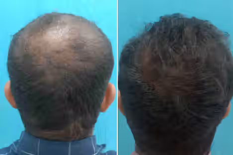 Hair loss in men